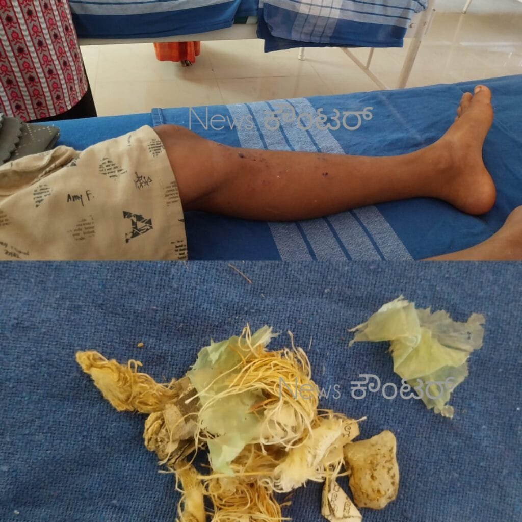 IMG-20260219-WA0000-1024x1024 ಬಂದಾರು ಮನೆಯಂಗಳದಲ್ಲಿ ಮಕ್ಳಳು 'ಬಾಲ್' ಎಂದು ಕ್ರಿಕೆಟ್ ಆಟವಾಡುತ್ತಿದ್ದ ವೇಳೆ ಸ್ಫೋಟ ; ಬಾಲಕನಿಗೆ ಗಾಯ